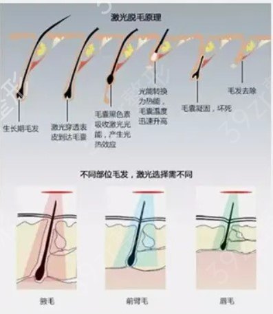 四川友谊医院整形科激光脱毛案例