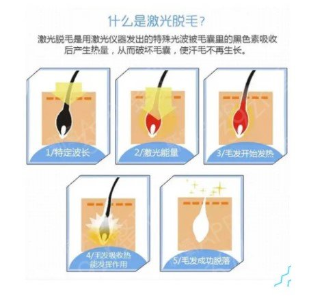 四川友谊医院整形科激光脱毛案例