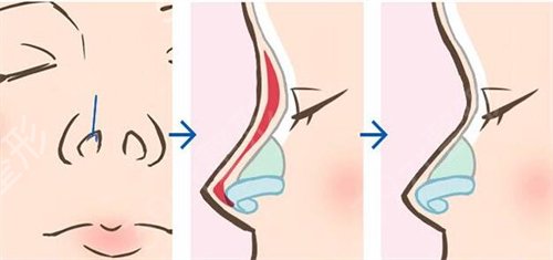 广州海峡军做鼻子好不好?一览医生成功隆鼻案例展示