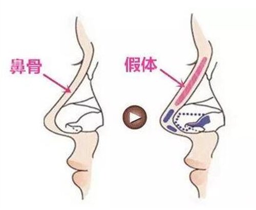 广州海峡军做鼻子好不好?一览医生成功隆鼻案例展示