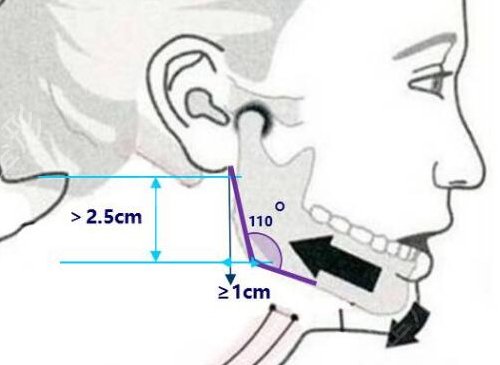 北京中日友好曾高好吗?附曾高颧骨磨骨案例参考一览