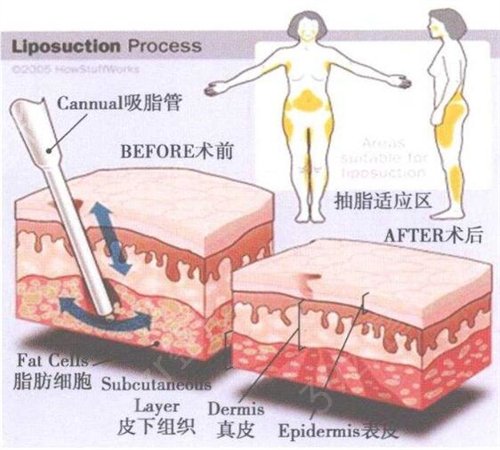 北京处马桂娥医生简介及吸脂真实*果图分享一览