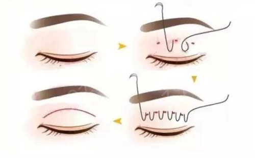 蚌埠田宇虹割双眼皮怎么样？看我真实恢复*果图