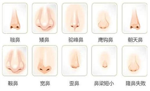 北京正美郑永生歪鼻矫正