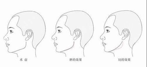 北京联合丽格何照华磨骨案例，分享我的下颌角磨骨心得体会