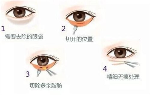 上海华东医院整形外科祛眼袋如何?价格表和真实*果一览