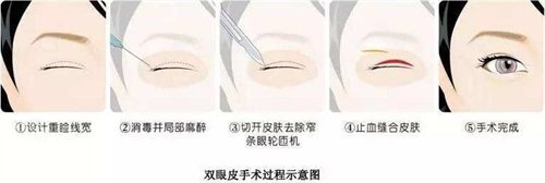 潍坊医学院整形外科价格表2020版，双眼皮真实*果公布