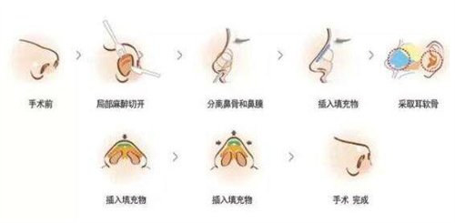 隆鼻一辈子不取线可以吗?