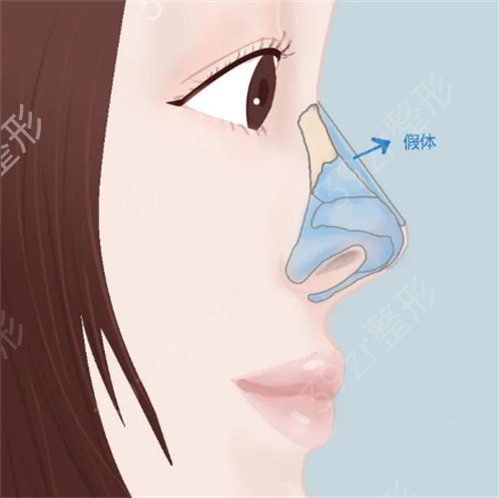 赣州亚韩耳软骨隆鼻收费一万贵吗？追加耳软骨隆鼻优势及案例图