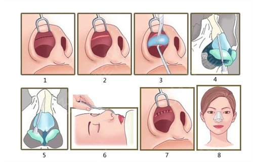 歪鼻矫正的*果怎么样？手术方式求科普？