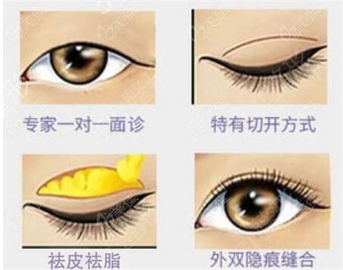 重庆西南医院王量双眼皮价格表明细公布，附案例恢复过程