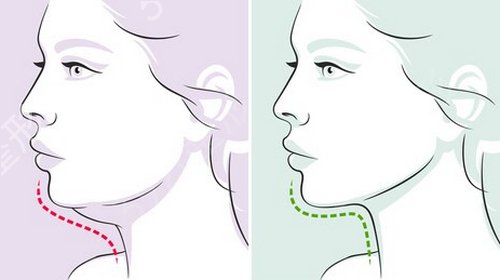 盘点面部吸脂瘦脸后遗症，术后需要注意什么？