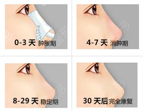 隆鼻后取出假体常见问题分析，含术后注意事项