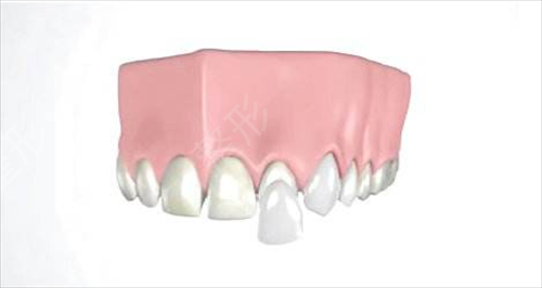 瓷贴面会对牙齿造成损害吗？价格是多少？