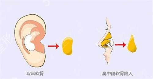 膨体隆鼻假体取出后差别大吗?术后注意事项分享