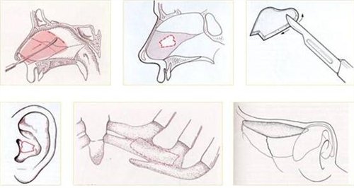 膨体隆鼻假体取出后差别大吗?术后注意事项分享