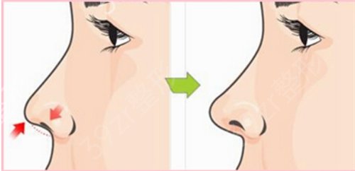 假体隆鼻后如何防止透光?需要注意这几点