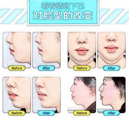 下巴后缩如何改良，不同情况适合不同的手术方式