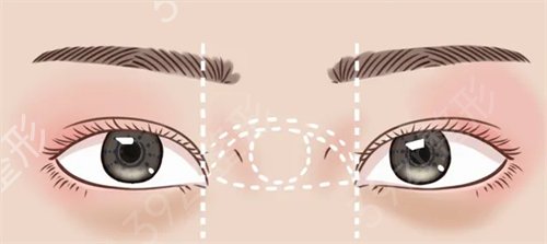 【科普篇】眼部整形后的必定需要经过的恢复阶段