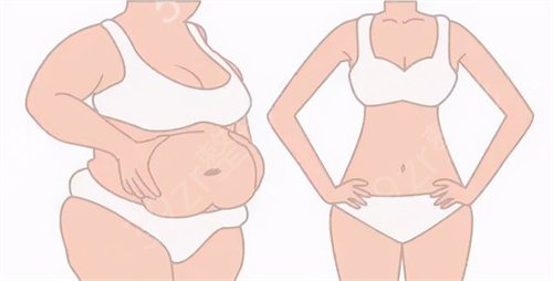腰腹吸脂后多久开始瘦？体重会减轻吗？