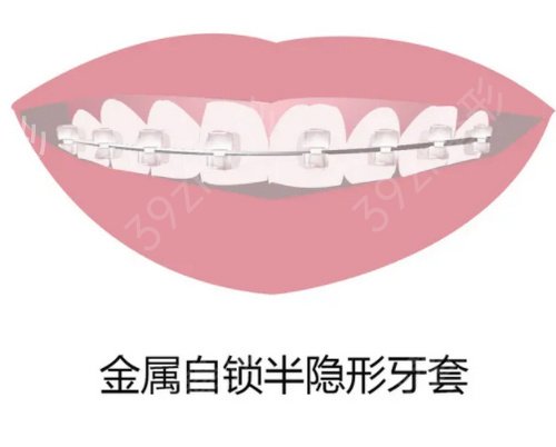 天津医科大学口腔医院牙齿矫正案例
