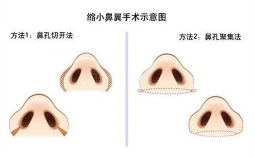 北京整鼻子多少钱？鼻整形种类有哪些？