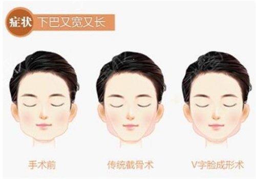 上海九院整形科擅长什么----下颌角整形真人案例恢复图一览