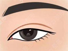 如何应对埋线双眼皮感染？