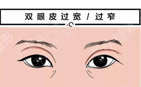 省中刘育凤双眼皮修复案例