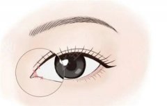 韩式开眼角的手术方法是什么?韩式开眼角有什么优点?