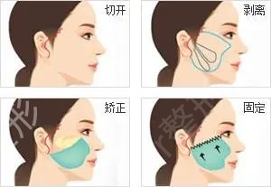 北京面部提升专家介绍强，真实案例考察医生实力