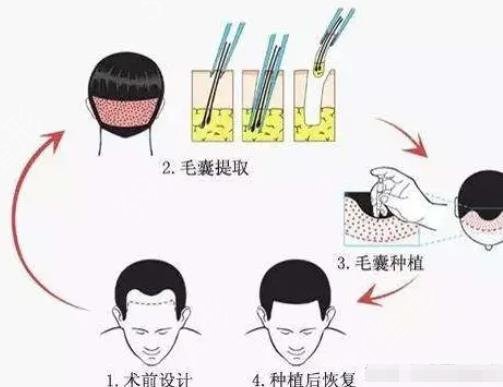 【】全国植发医生介绍甲，坐诊医院揭晓！