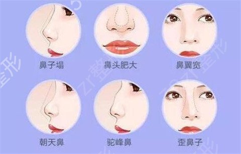 上海薇琳曹芳隆鼻术后果图分享！还有真实信息