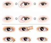 眼综合包括哪些？眼综合一般多久恢复？