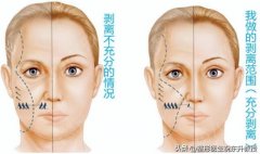 关于面部五层提升手术，这10个技术细节，术前必须了解清楚