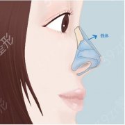 硅胶假体隆鼻的优点有哪些？性高不高？