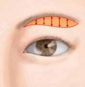 提眉手术是拆线的好还是不拆线的好？