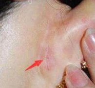 耳软骨隆鼻会被吸收吗？