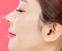 耳软骨垫鼻尖的果怎么样，会导致增生吗