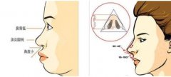 假体隆鼻和自体软骨隆鼻要怎么选?