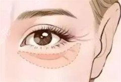 激光去眼袋后需多久能恢复？为何做完去眼袋手术后老流泪？