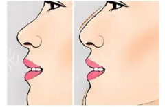 假体隆鼻修复有哪些注意事项