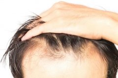 脱发严重是什么原因引起的？