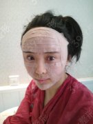 现在是做完面部年轻化手术后的第十二天了，现在我的脸已经没有那么肿胀了
