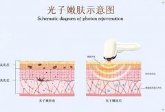 光子嫩肤一般能维持多久？停了会反弹吗？光子嫩肤价格概况分享