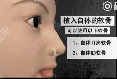 王宏伟隆鼻医生案例分享，王宏伟医生隆鼻技术解析