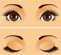 眼睑吸脂术有哪些优点？消肿需要多长时间