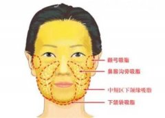 面部吸脂的效果是永久性的吗？