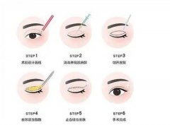 双眼皮切开术有什么副作用？