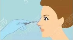 软骨注射隆鼻和胶原蛋白注射隆鼻有什么不同？